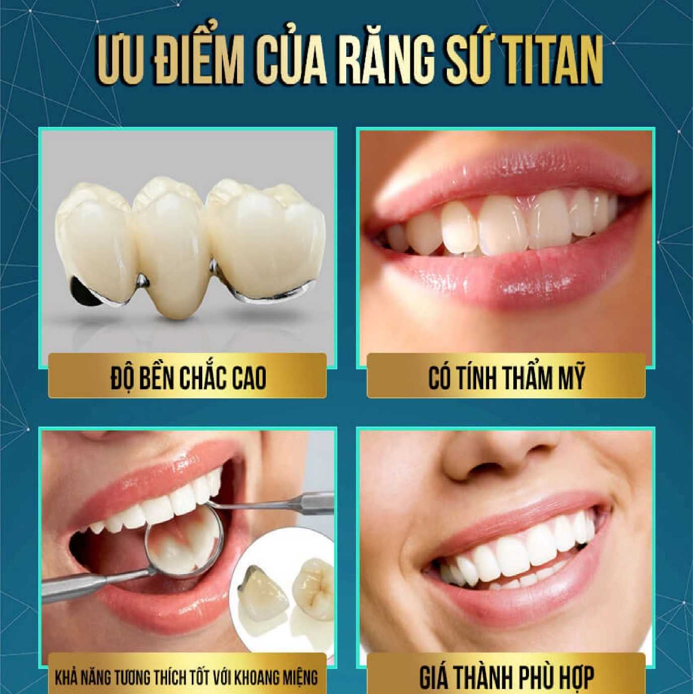 Ưu điểm vượt trội của răng sứ titan