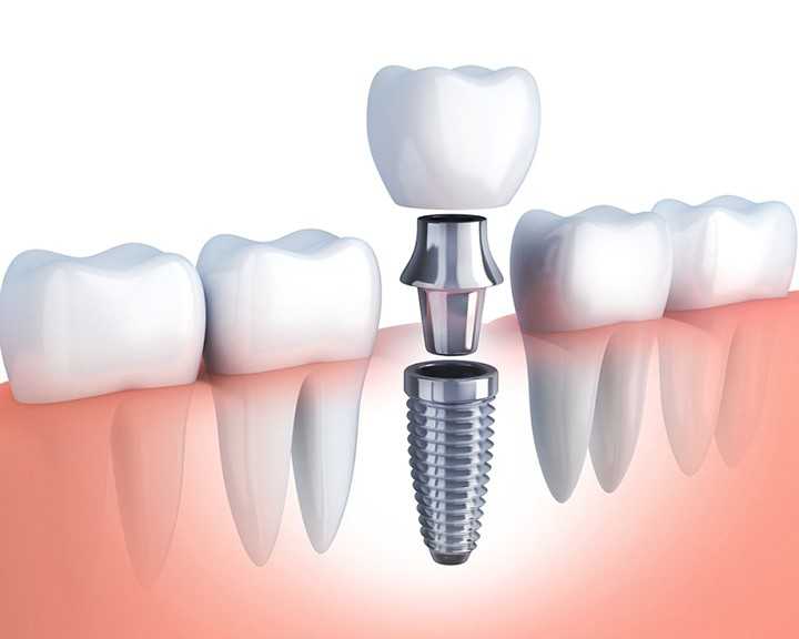 Trồng răng Implant là phương pháp phổ biến khi mất răng