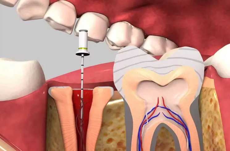 Không phải trường hợp nào cũng cần lấy tủy răng