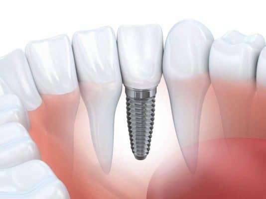 Implant nha khoa là giải pháp thẩm mỹ răng hiệu quả