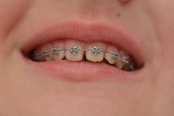 Niềng răng trong độ tuổi 10-17 tuổi là tốt nhất