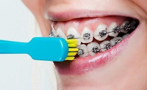 Vệ sinh răng miệng cẩn thận sau khi niềng răng để tránh các bệnh lý về răng miệng