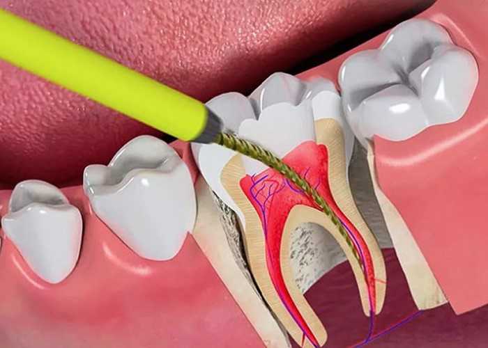 Điều trị tủy răng giúp kéo dài khả năng ăn nhai