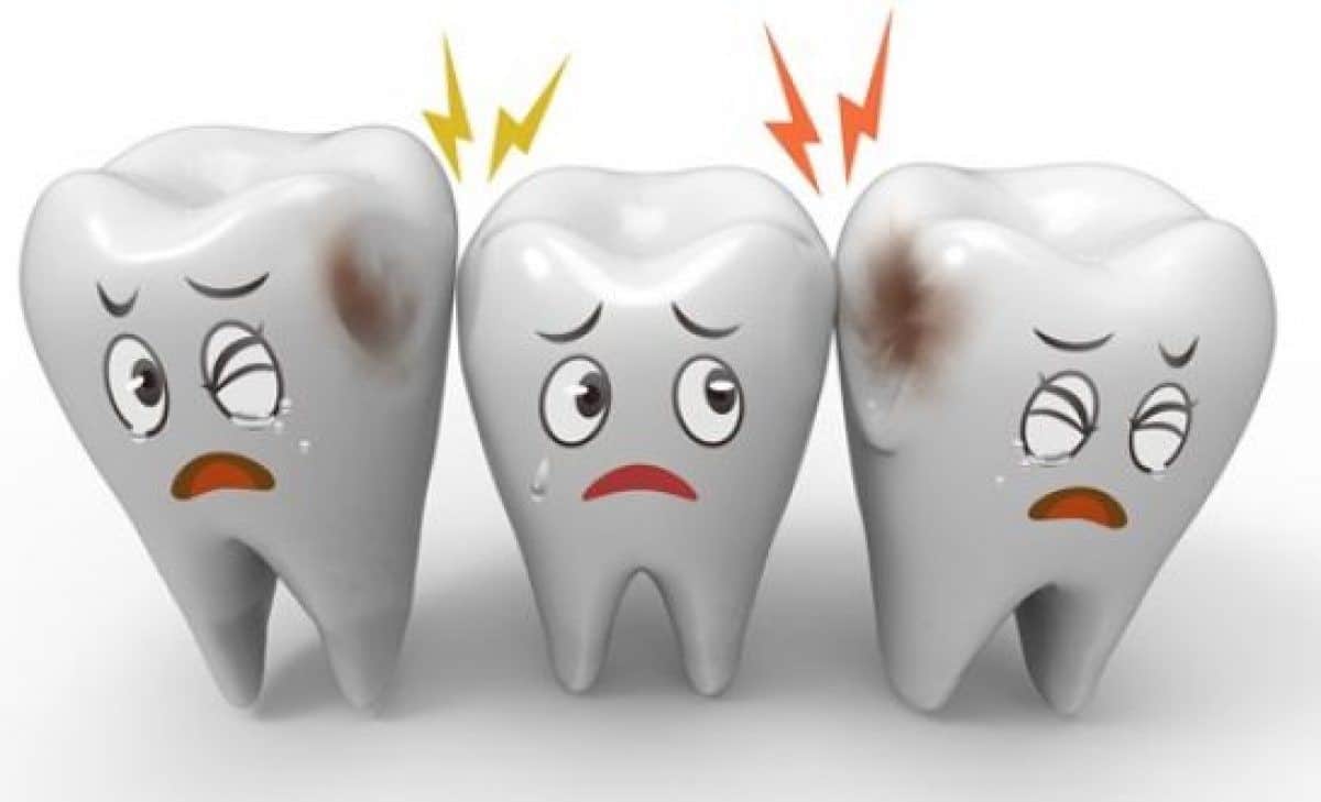 Bạn bị sâu răng thì không nên tẩy trắng răng