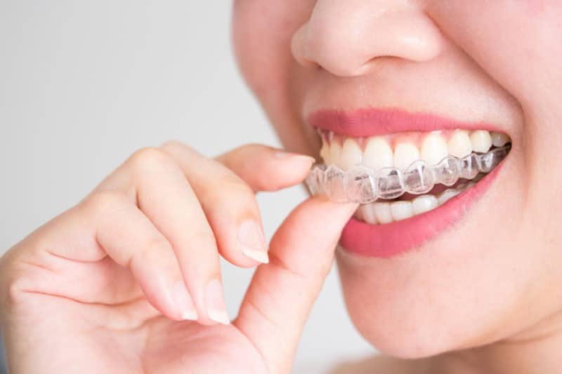 Niềng răng không mắc cài Invisalign có nhiều ưu điểm nổi bật