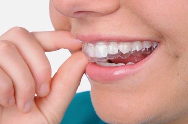 Nụ cười đẹp hoàn hảo với niềng răng trong suốt invisalign