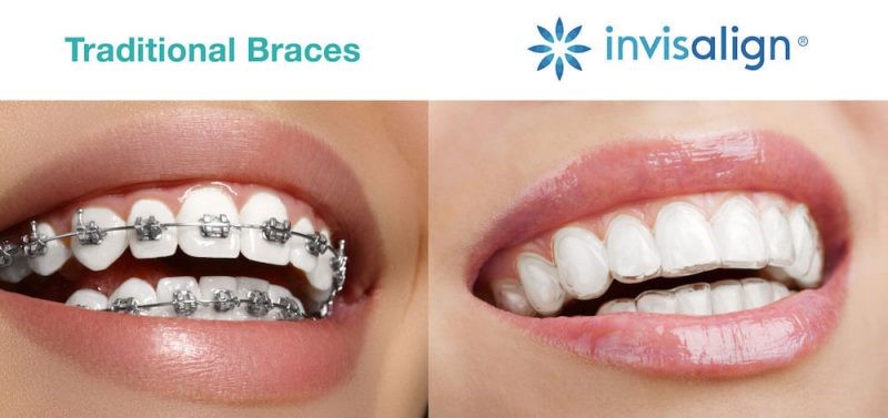 Ưu điểm nổi bật của niềng răng Invisalign so với truyền thống