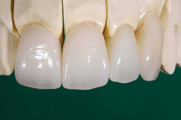 Phục hình răng sứ giúp khắc phục những khuyết điểm của răng