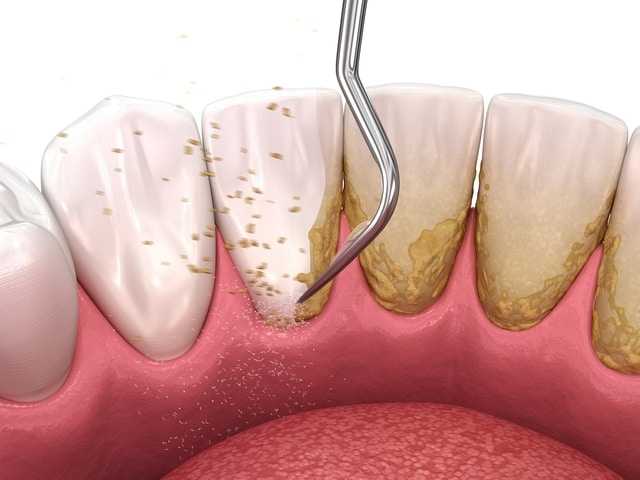 Bác sĩ tiến hành loại bỏ cao răng bằng dụng cụ chuyên dụng