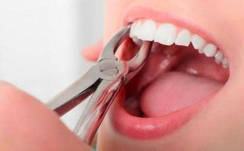 Thông thường sẽ nhổ răng số 4,5,8 nếu có chỉ định nhổ răng của bác sĩ
