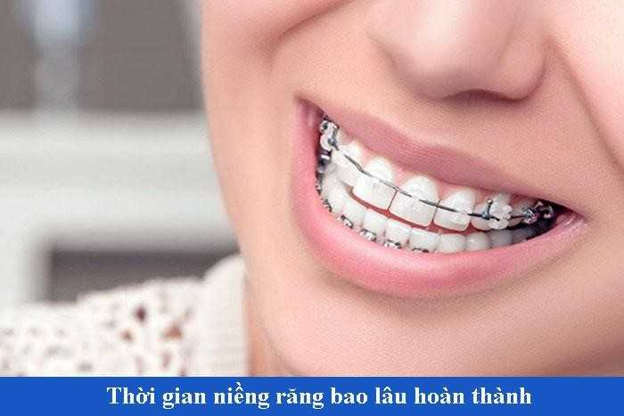 Người lớn niềng răng trong bao lâu thì có kết quả?