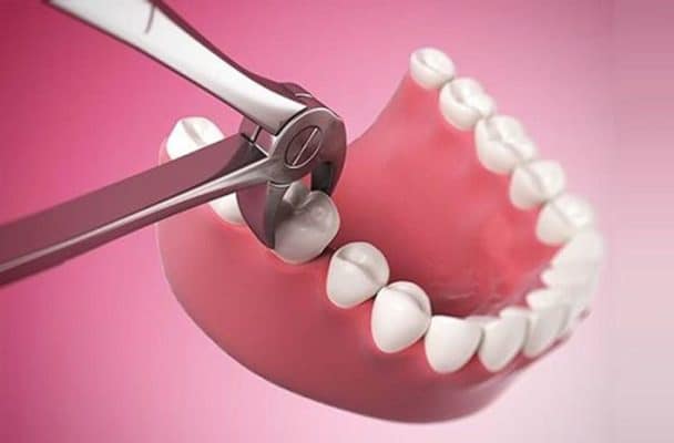 Nhổ răng khôn có sự khác biệt với nhổ răng thường