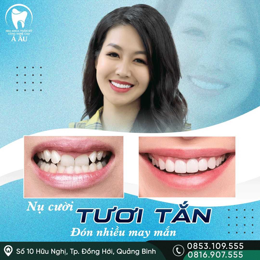 Niềng răng khấp khểnh đem lại nụ cười tươi tắn