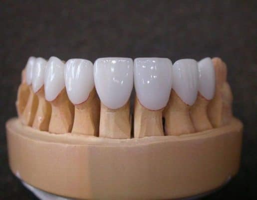 Răng sứ titan phù hợp cho những ai không đòi hỏi tính thẩm mỹ