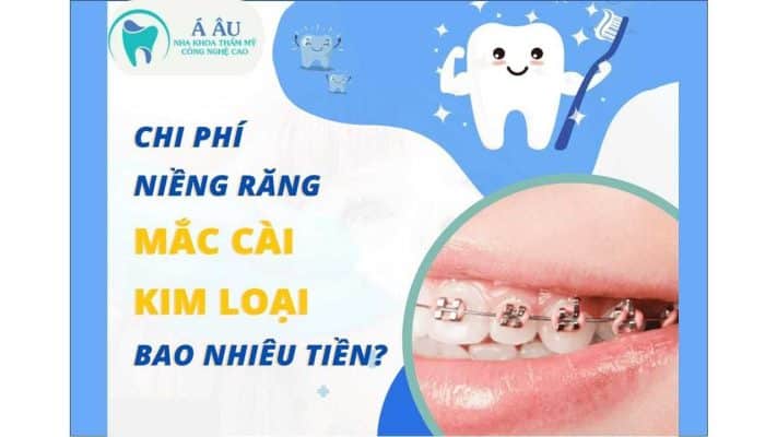 Giá niềng răng mắc cài kim loại truyền thống phù hợp với mọi đối tượng