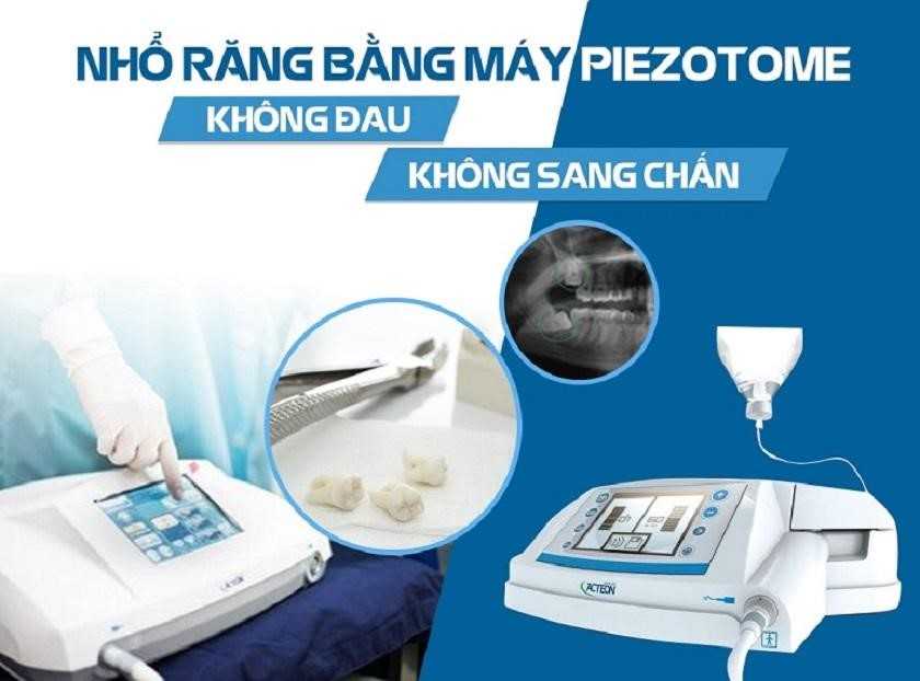 Ứng dụng máy nhổ răng Piezotome để nhổ răng không đau