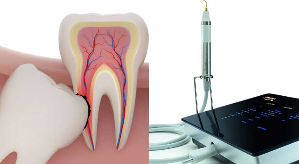 Nhổ răng khôn bằng công nghệ siêu âm Piezotome hiện đại