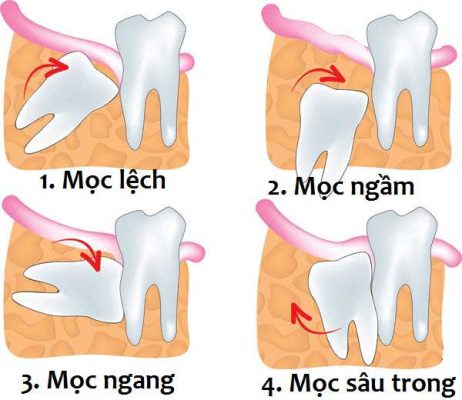 Răng khôn mọc chèn răng số 7 cần phải nhổ bỏ