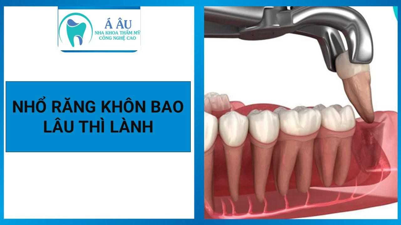 Nhổ răng khôn bao lâu thì lành? Vết thương vị trí nhổ răng khôn sẽ lành sau 1- 2 tuần