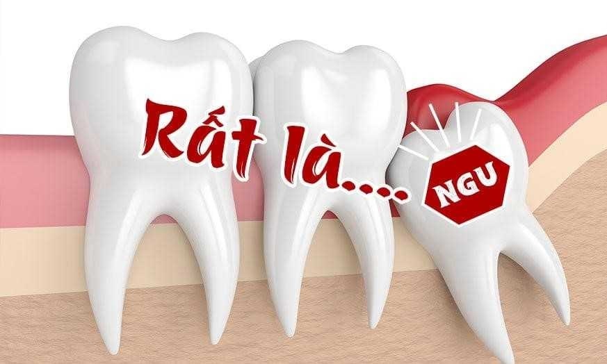 Rất nhiều trường hợp răng khôn mọc lệch gây đau nhức