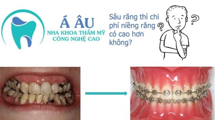 Niềng răng bao nhiêu tiền 1 hàm phụ thuộc vào tình trạng răng miệng trước khi niềng