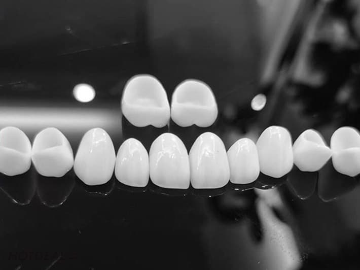 Răng toàn sứ Zirconia có nhiều ưu điểm vượt trội hơn so với các dòng răng kim loại