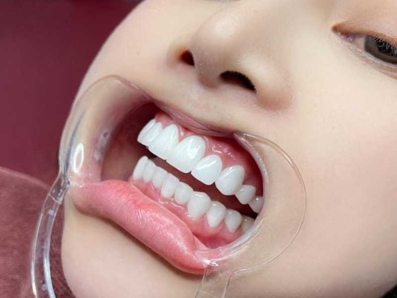 Làm răng sứ 4 cái răng cửa vừa tiết kiệm chi phí vừa mang lại nụ cười xinh