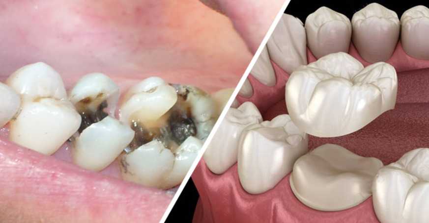 Bọc răng sứ xong có bị sâu không?