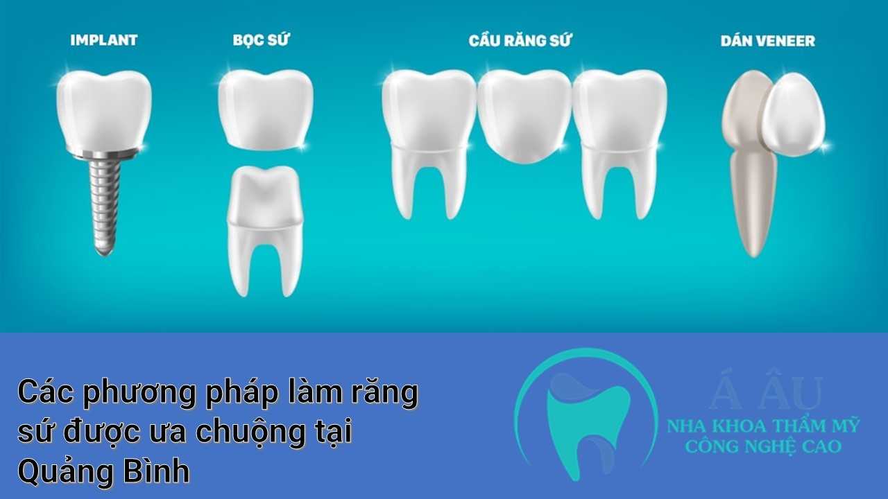 Phương pháp bọc răng sứ nào tốt ở Quảng Bình mà bạn nên thực hiện?