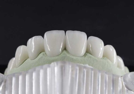 Răng sứ Zirconia đức được rất nhiều người ưa chuộng hiện nay