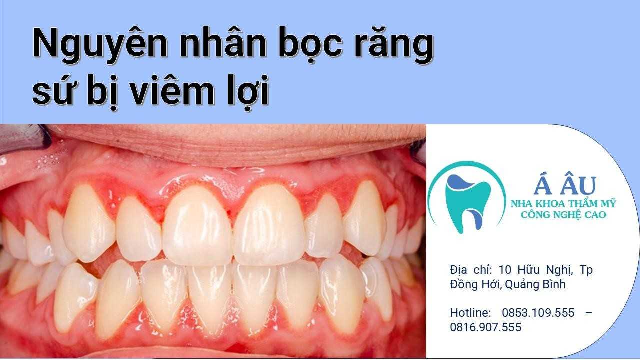 Bọc răng sứ bị viêm lợi do nhiều nguyên nhân khác nhau